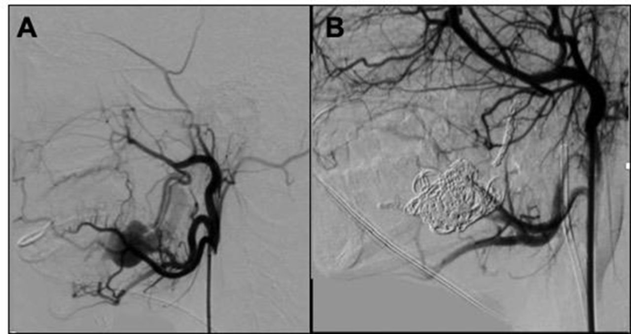 E-195 Head and neck arteriovenous malformations: university of ...