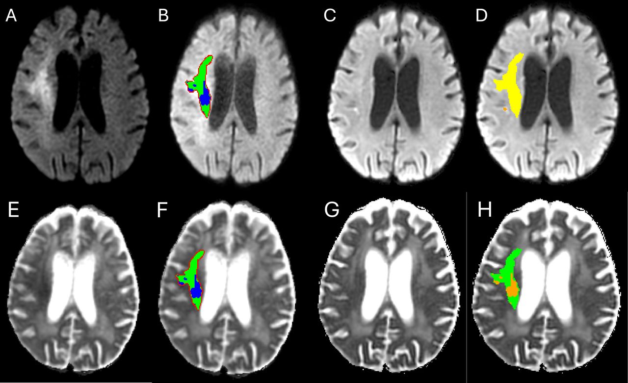 DWI-ADC mismatch predicts infarct growth rate and endovascular